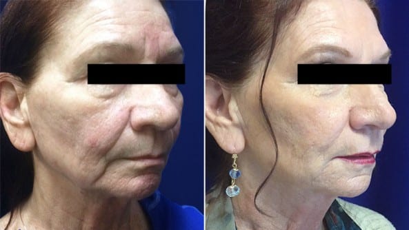 Before and After Image: Dermal Fillers - right-front-oblique