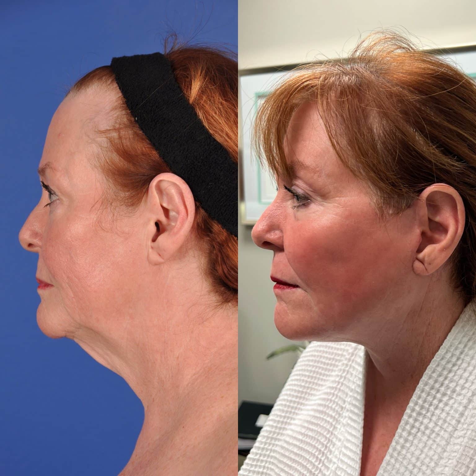 Before and After Image: Facial Plastic Surgery - left-side