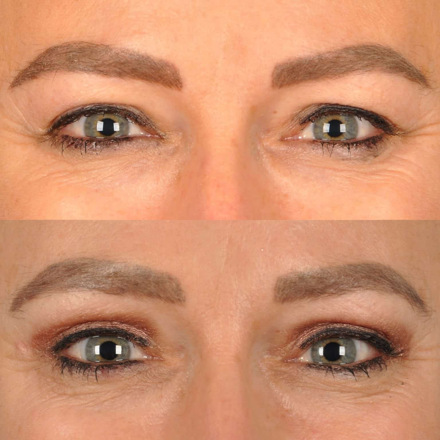 Before and After Image: Facial Plastic Surgery - front