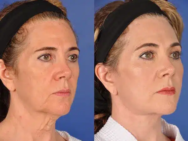 Before and After Image: Facial Plastic Surgery - right-front-oblique