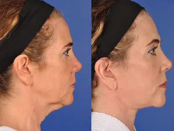 Before and After Image: Facial Plastic Surgery - right-side