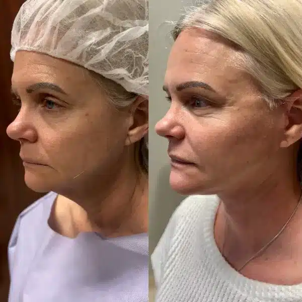 Before and After Image: Facial Plastic Surgery - left-front-oblique