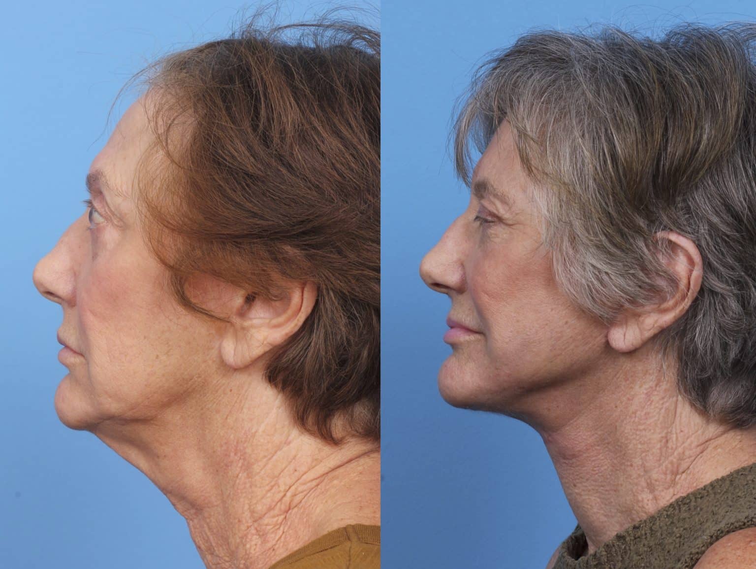Before and After Image: Facial Plastic Surgery - left-side