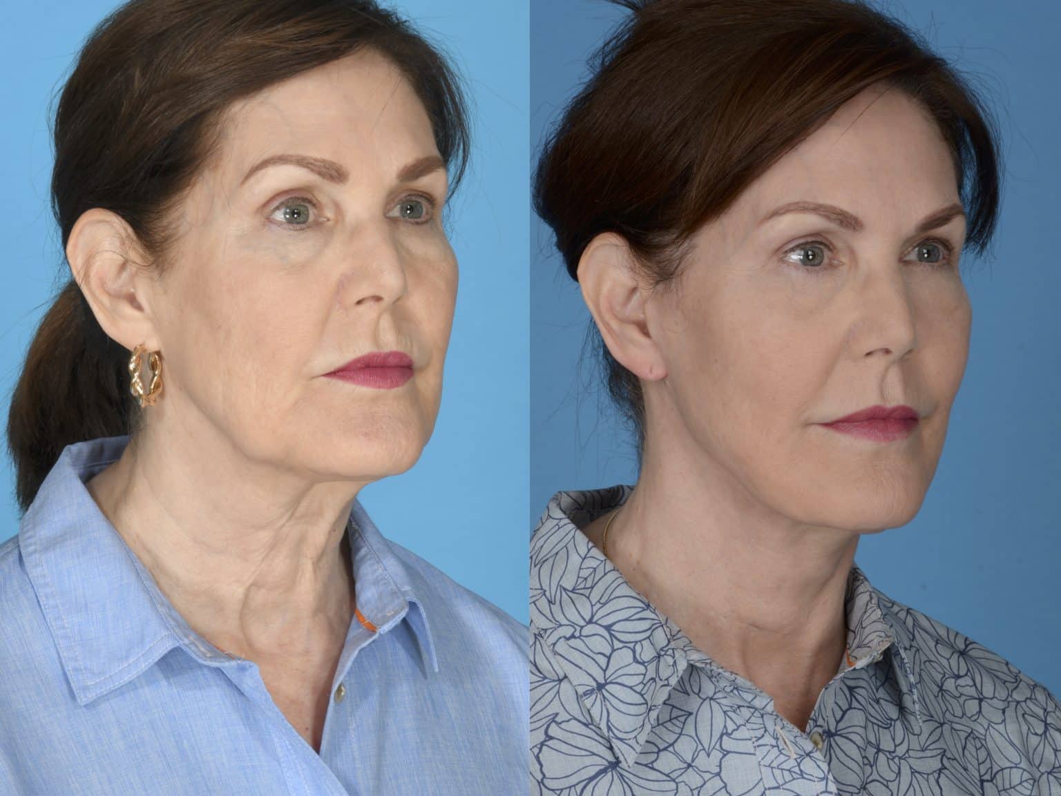 Before and After Image: Facial Plastic Surgery - right-front-oblique