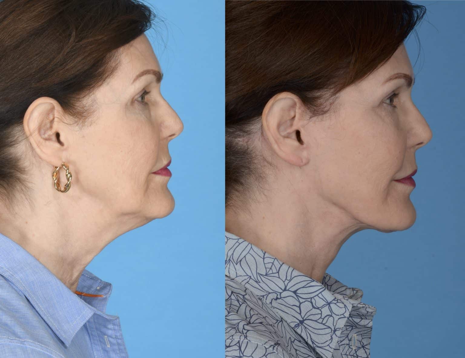 Before and After Image: Facial Plastic Surgery - right-side