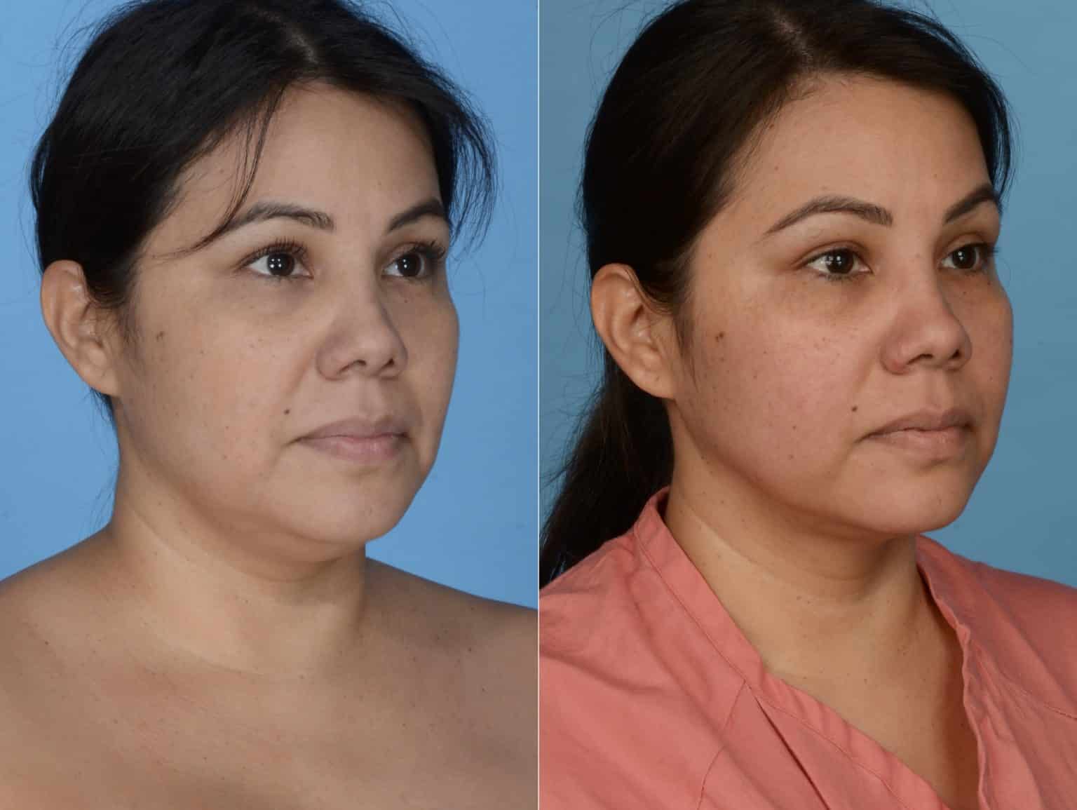 Before and After Image: Facial Plastic Surgery - right-front-oblique