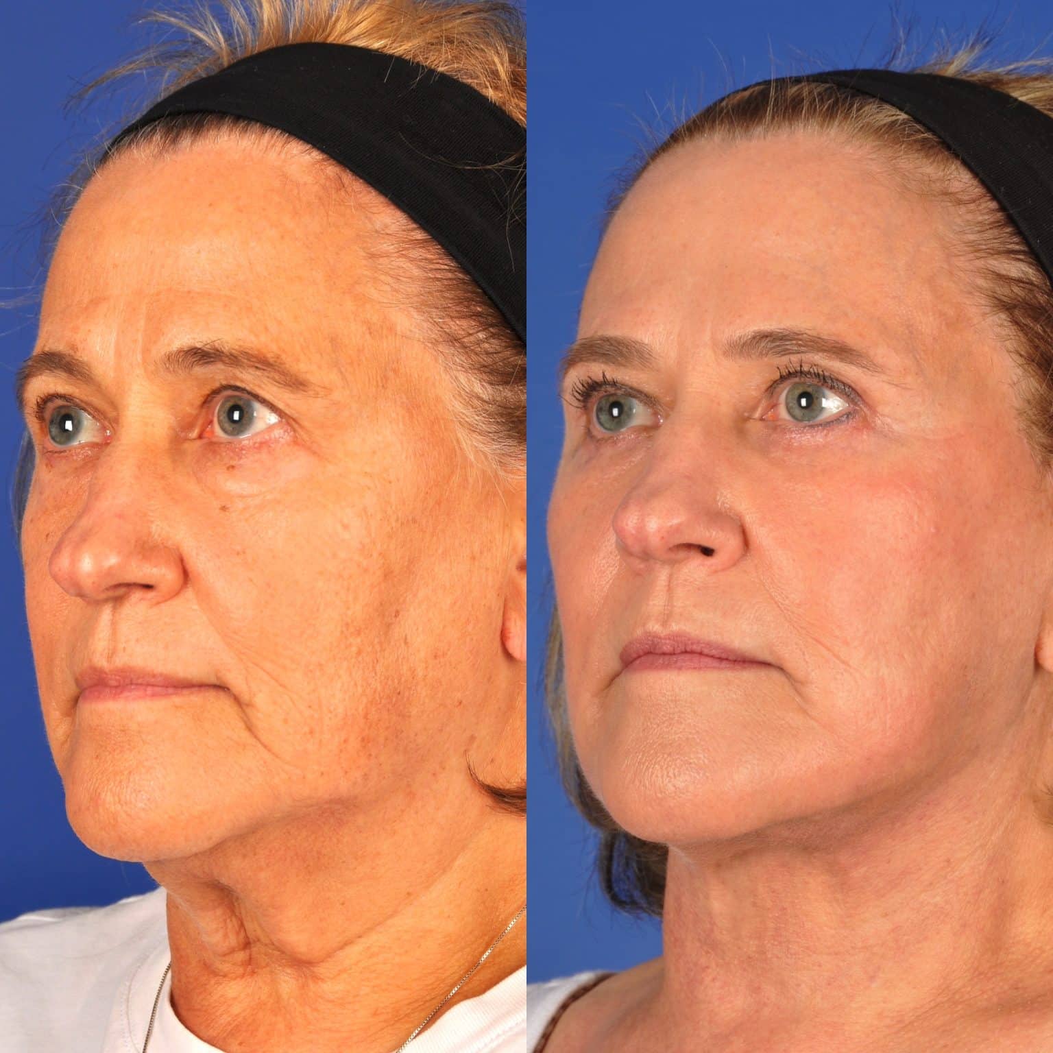 Before and After Image: Facial Plastic Surgery - left-front-oblique