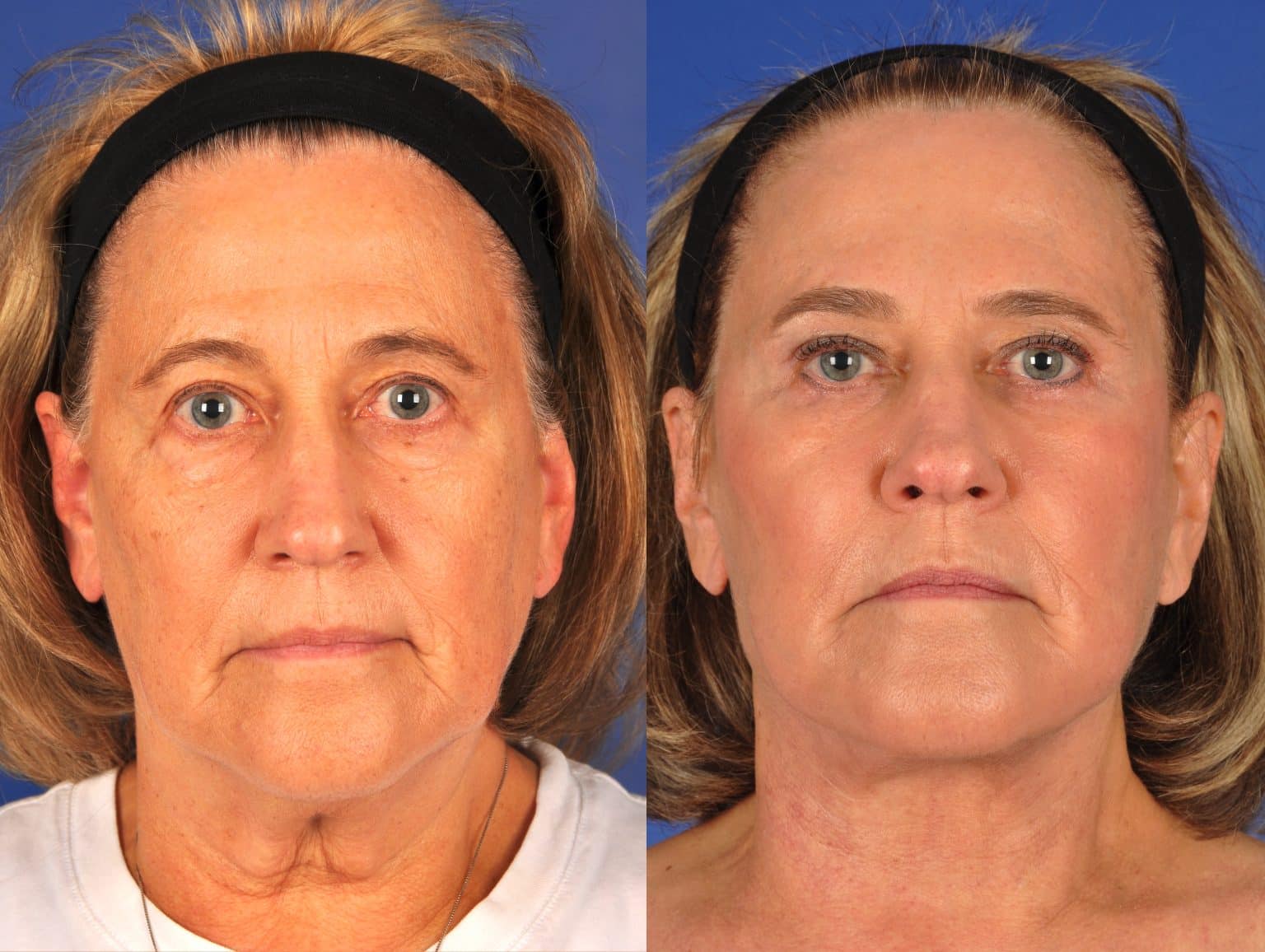 Before and After Image: Facial Plastic Surgery - front