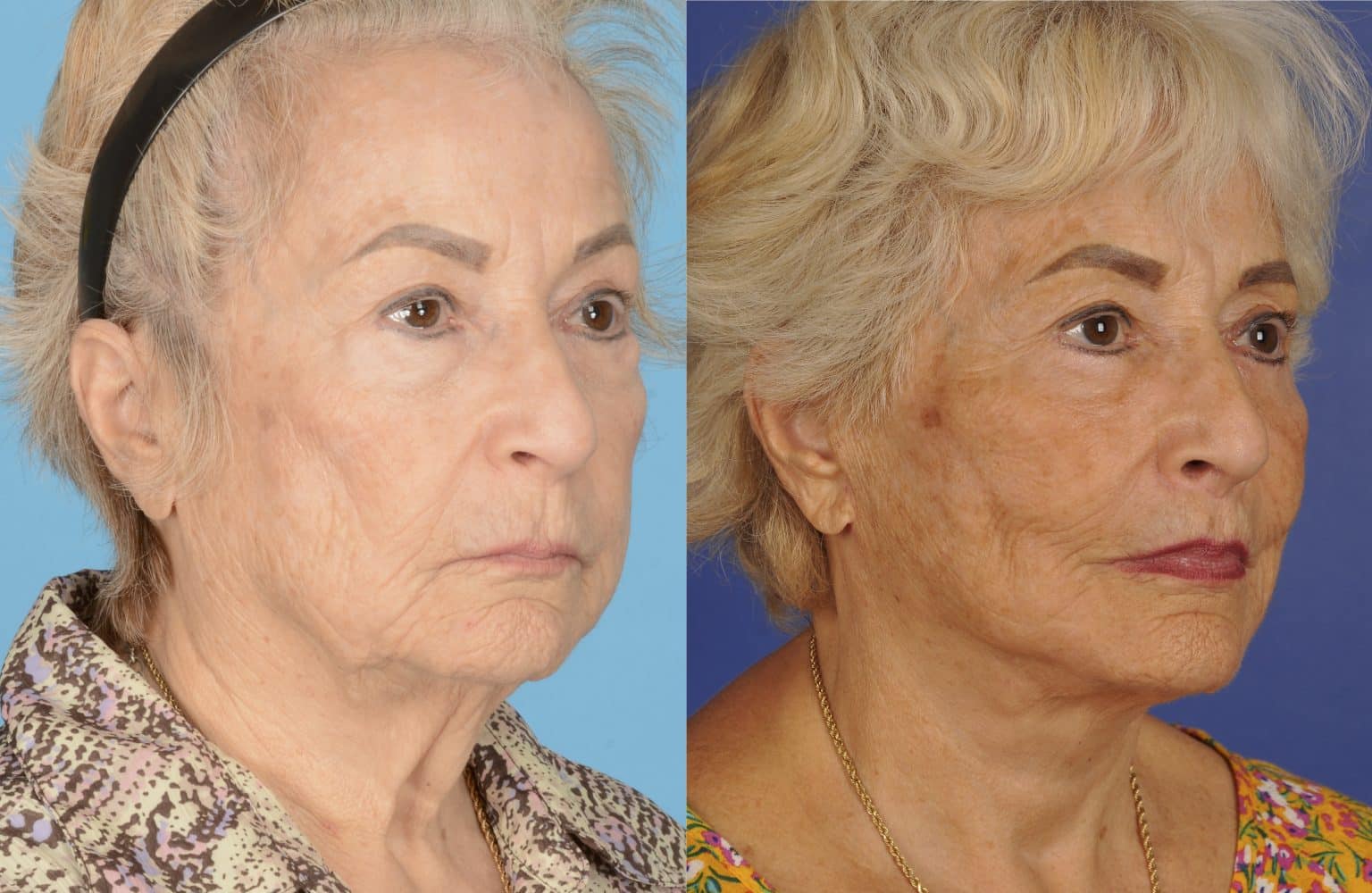 Before and After Image: Facial Plastic Surgery - right-front-oblique