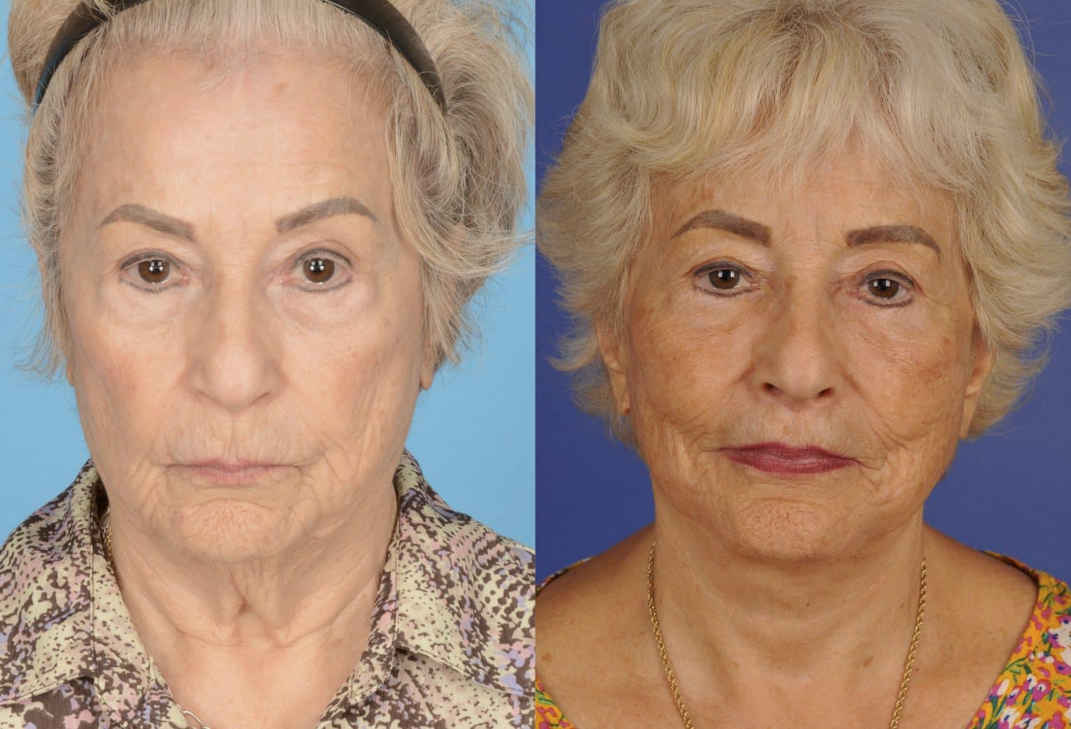 Before and After Image: Facial Plastic Surgery - front