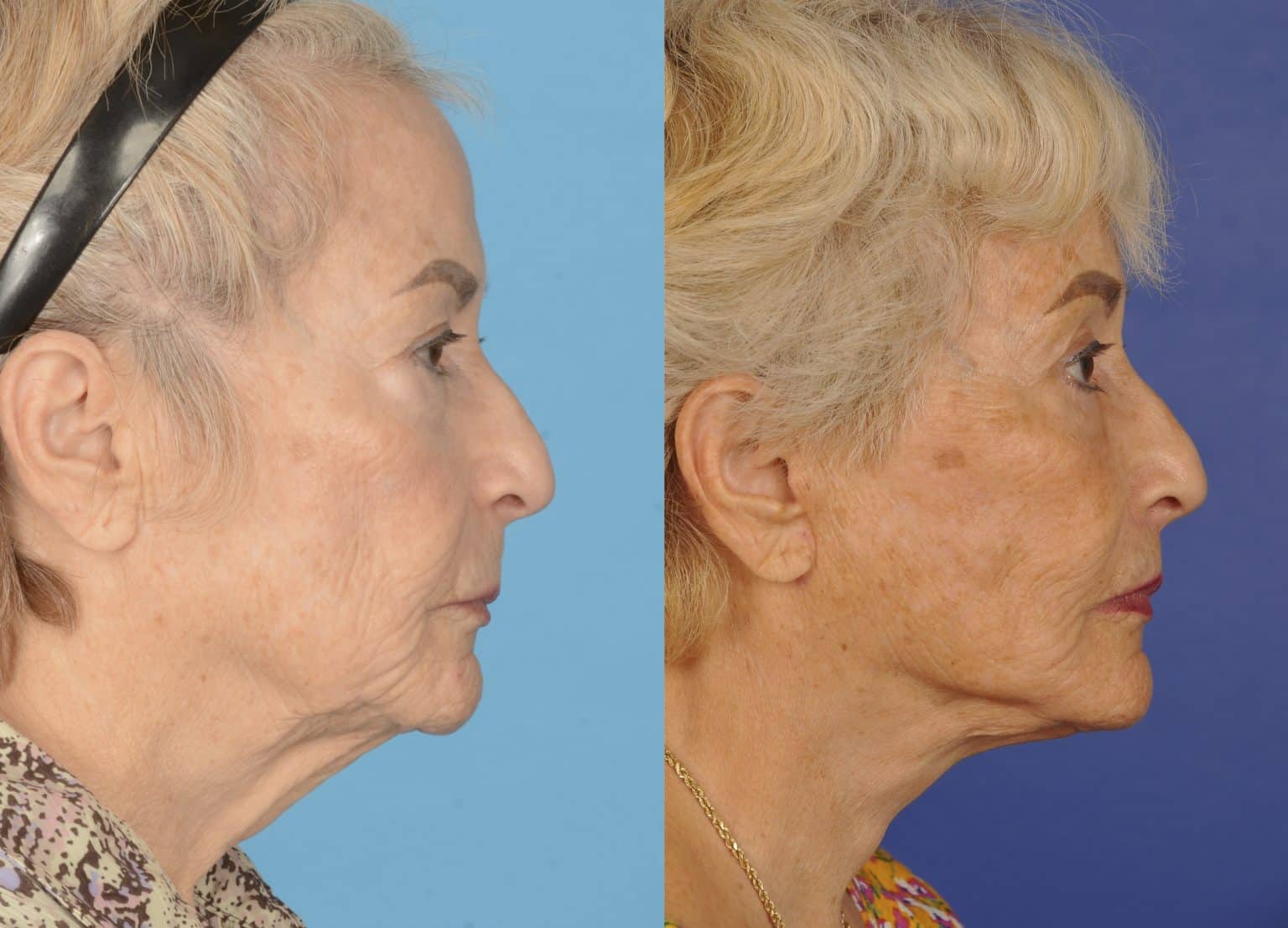 Before and After Image: Facial Plastic Surgery - right-side
