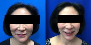Before and After Image: Halo Laser - front