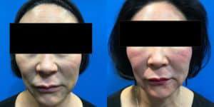 Before and After Image: Halo Laser - front