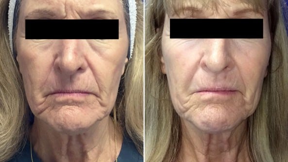 Before and After Image: Halo Laser - front