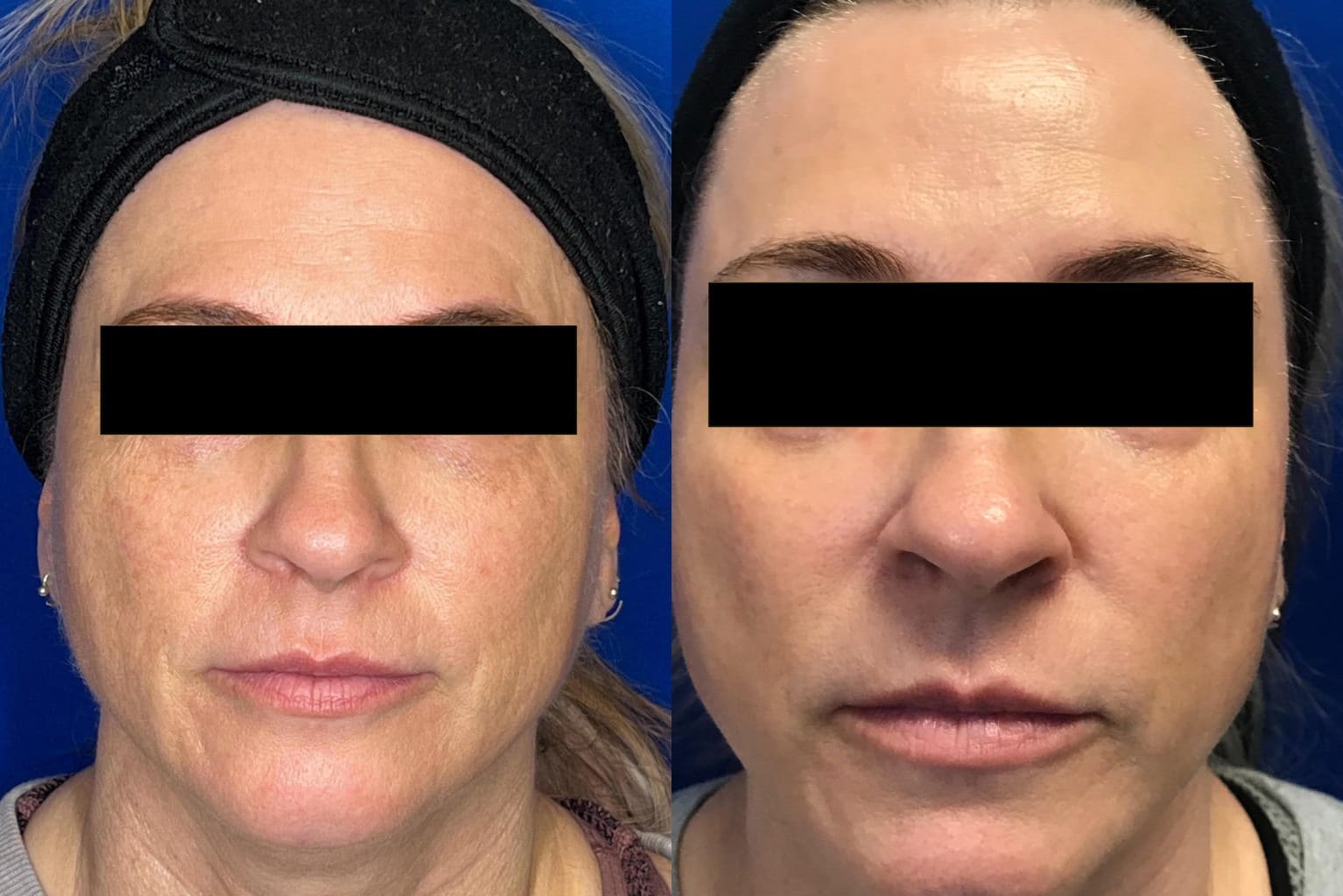 Before and After Image: Halo Laser - front