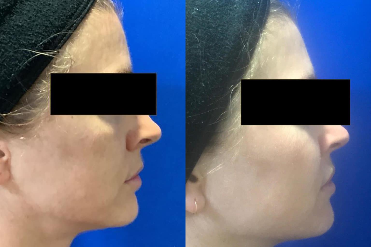 Before and After Image: Halo Laser - right-side