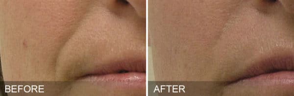 Before and After Image: Hydrafacial - right-front-oblique