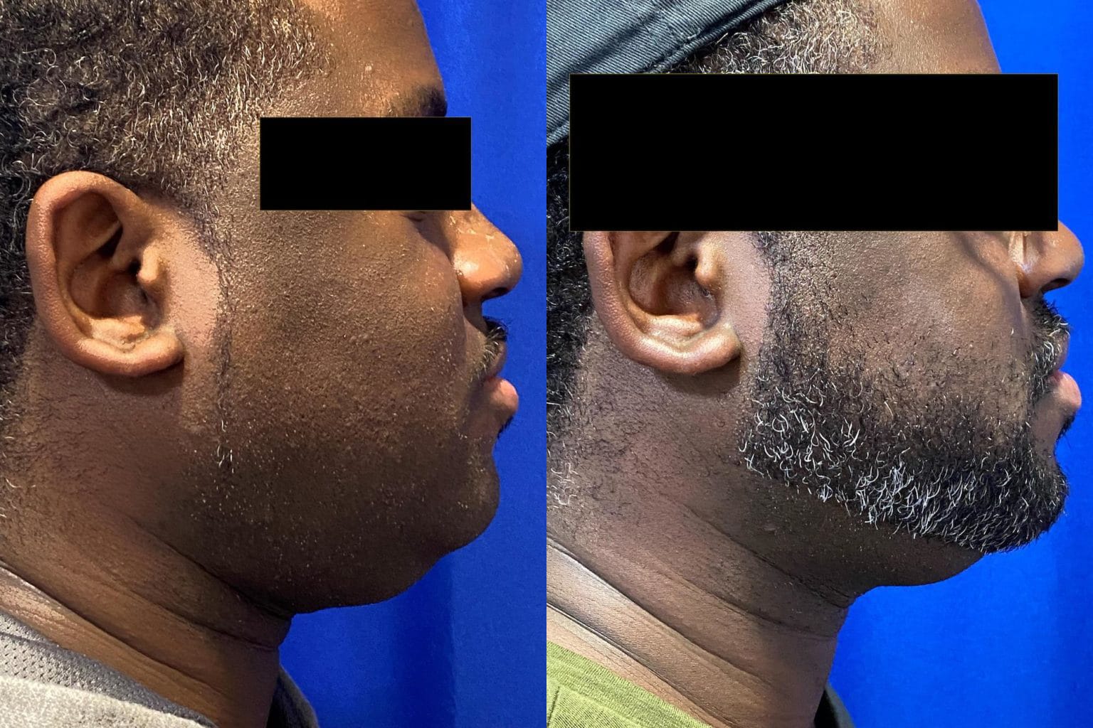 Before and After Image: Kybella - right-side