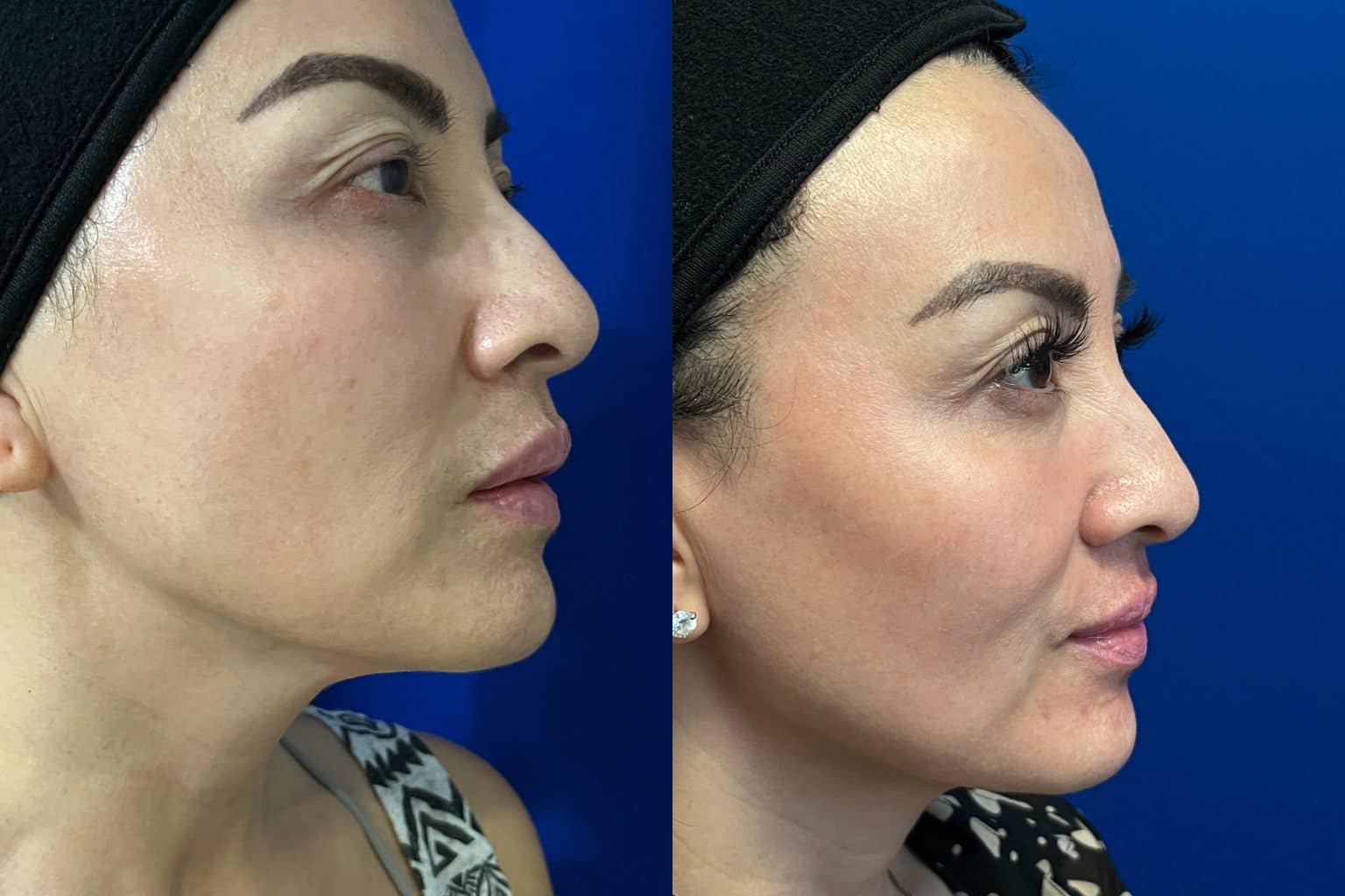 Before and After Image: Moxi Laser - right-side