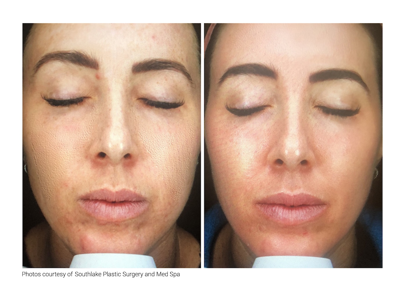 Before and After Image: Melange Peel - front