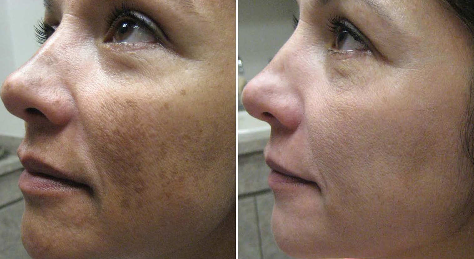 Before and After Image: Melange Peel - left-side