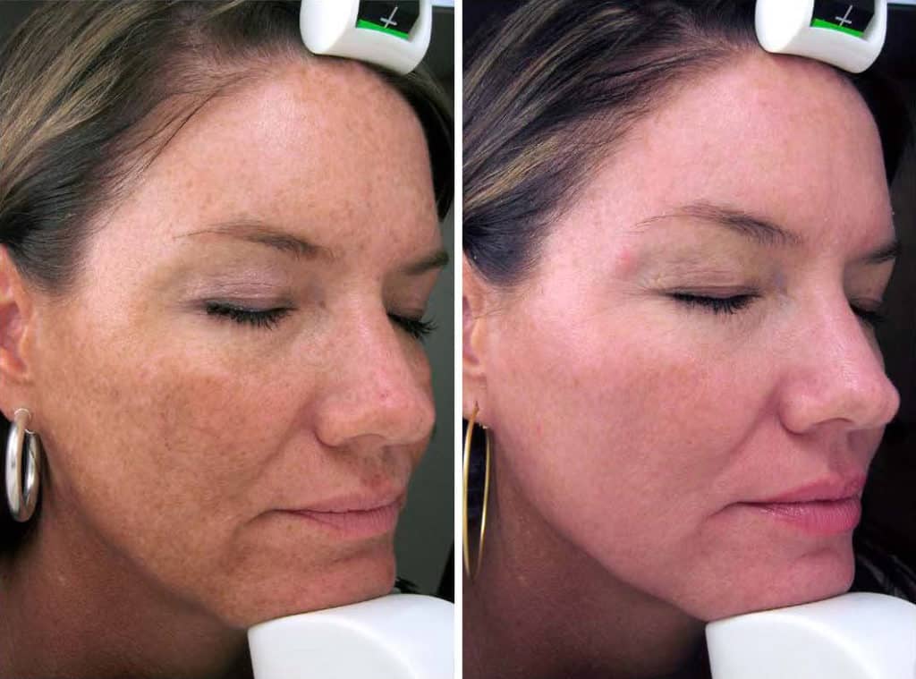 Before and After Image: Melange Peel - right-front-oblique