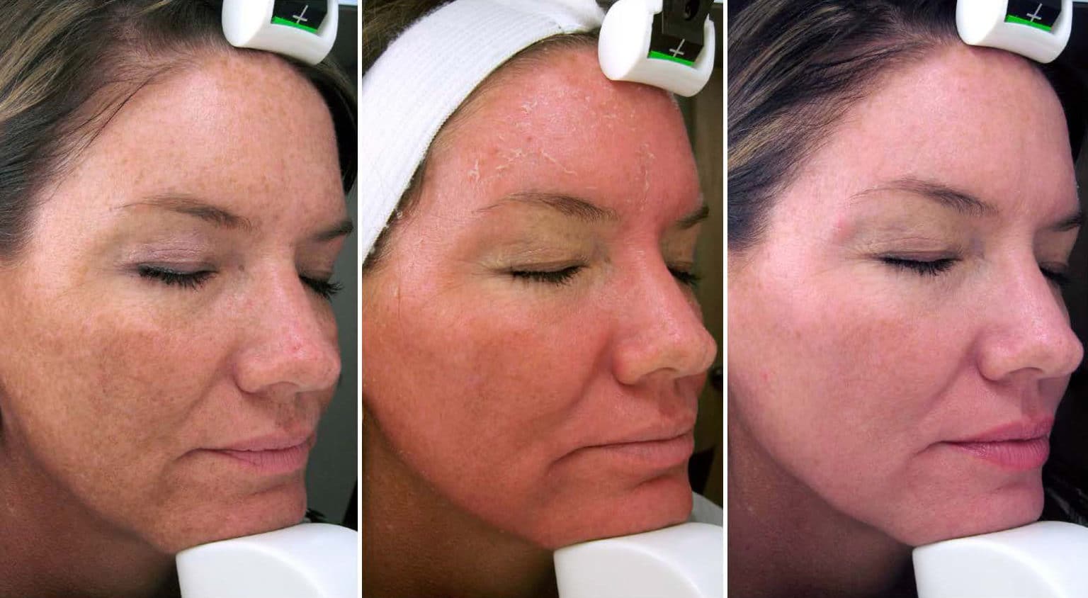 Before and After Image: Melange Peel - right-front-oblique