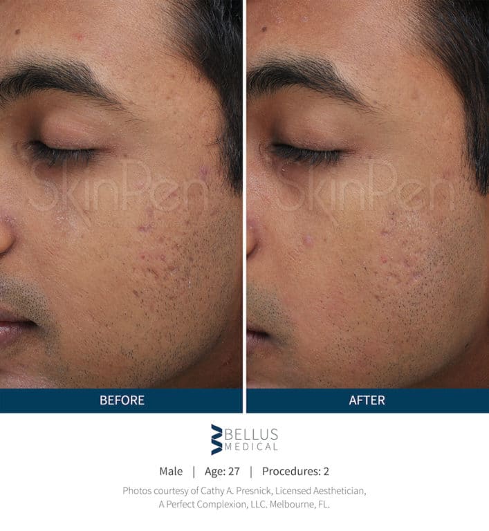 Before and After Image: Microneedling - left-front-oblique