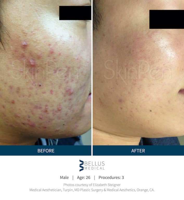Before and After Image: Microneedling - right-side