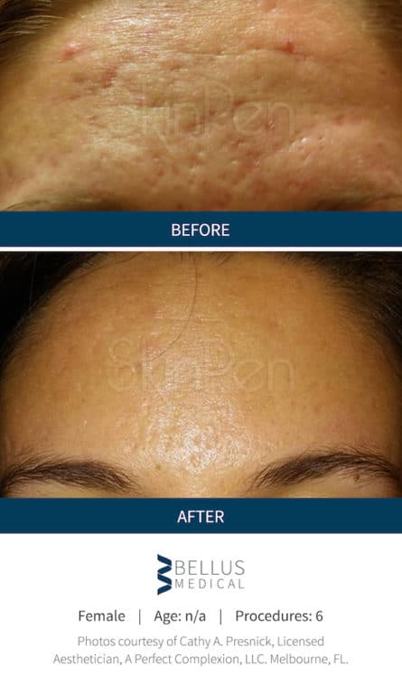 Before and After Image: Microneedling - front