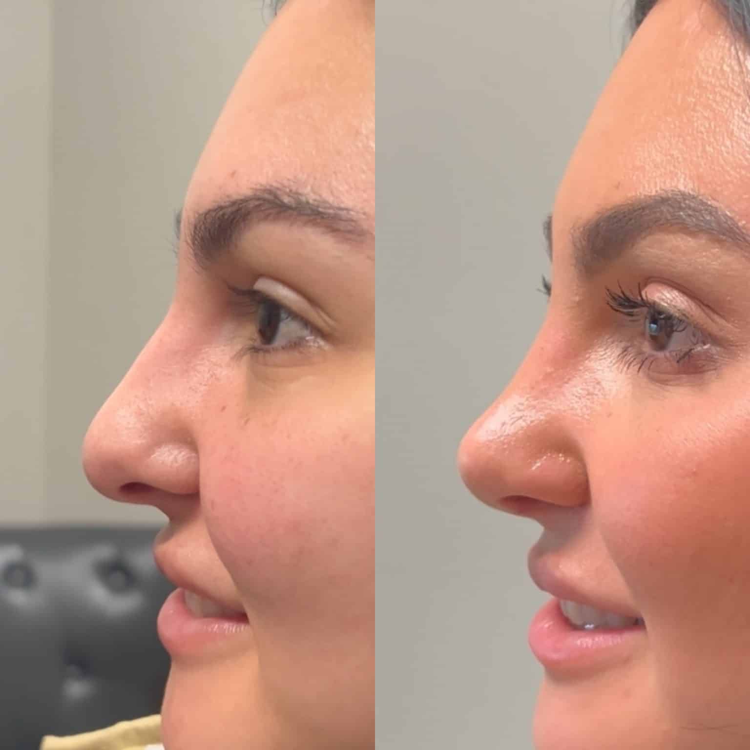 Before and After Image: Primary Rhinoplasty - left-side