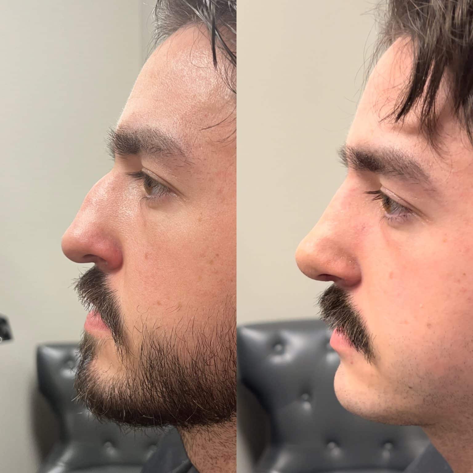 Before and After Image: Primary Rhinoplasty - left-side