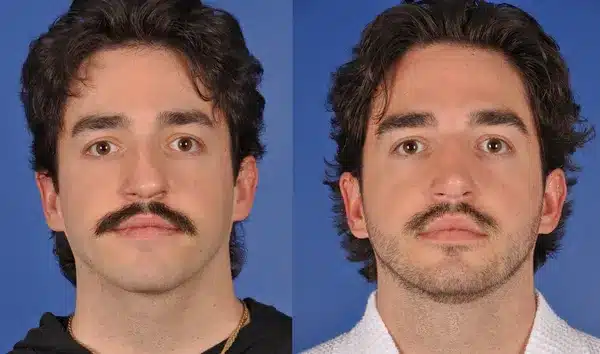 Before and After Image: Primary Rhinoplasty - front