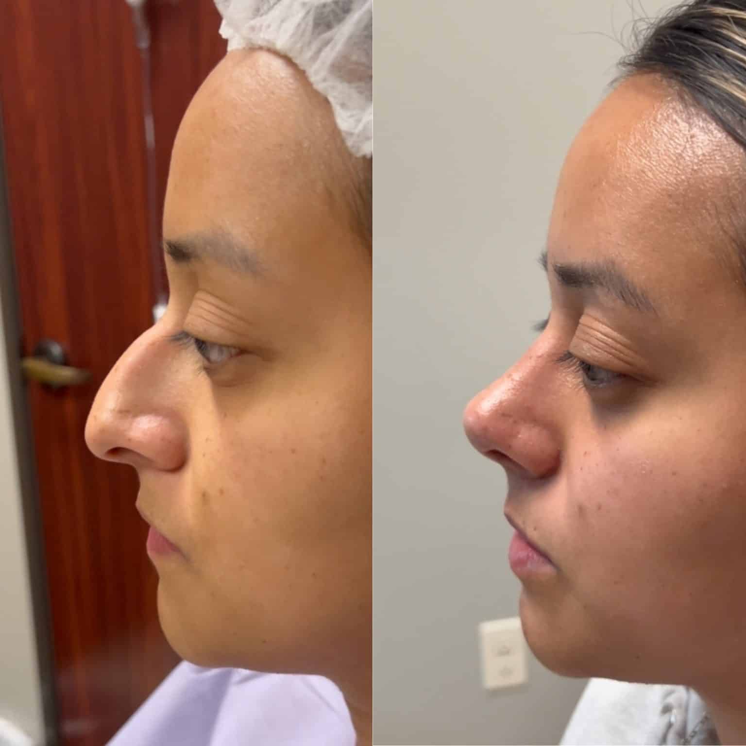 Before and After Image: Primary Rhinoplasty - left-side