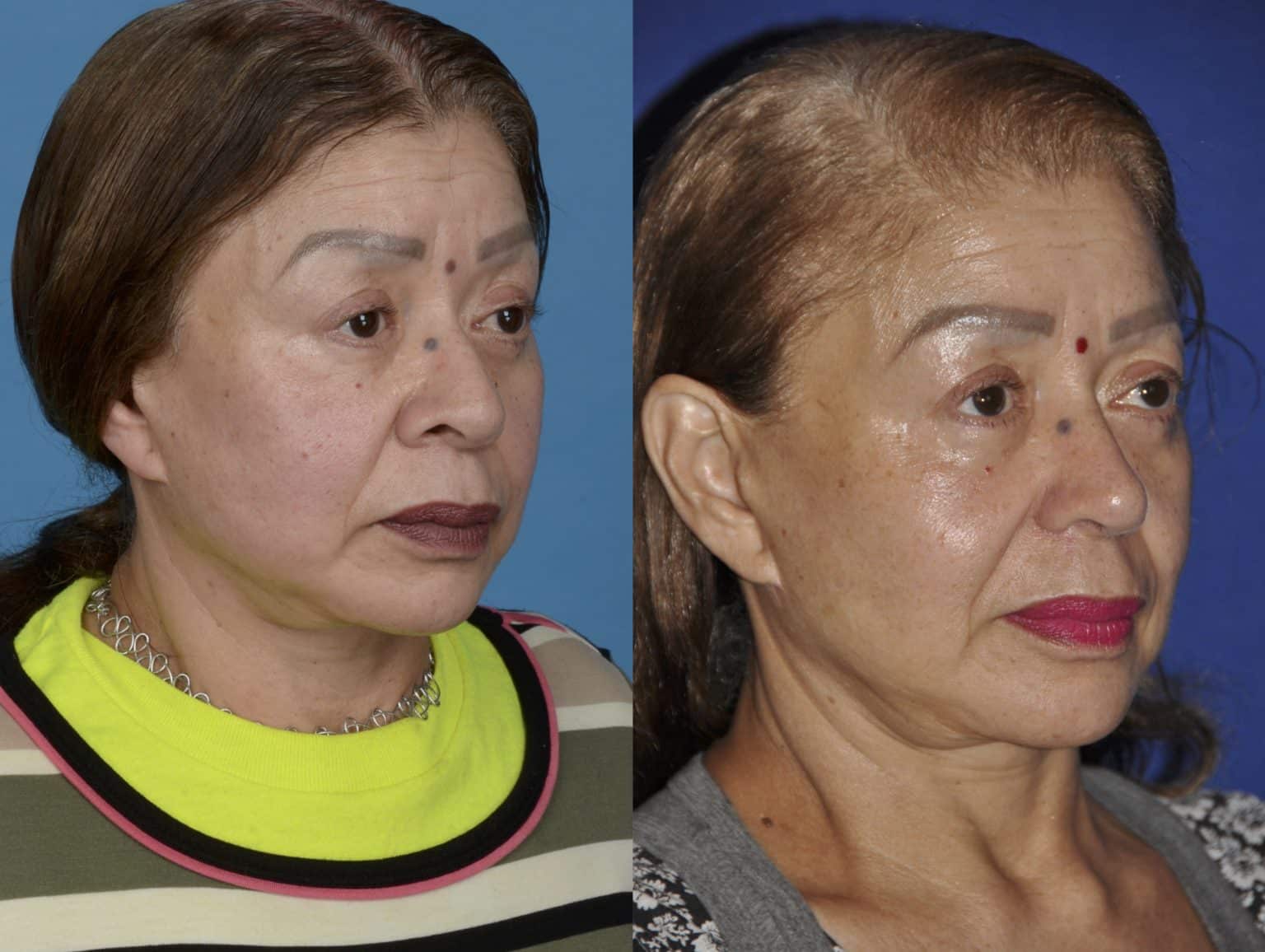 Before and After Image: Precision Rhinoplasty - right-front-oblique