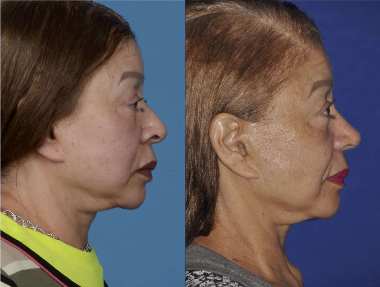 Before and After Image: Precision Rhinoplasty - right-side