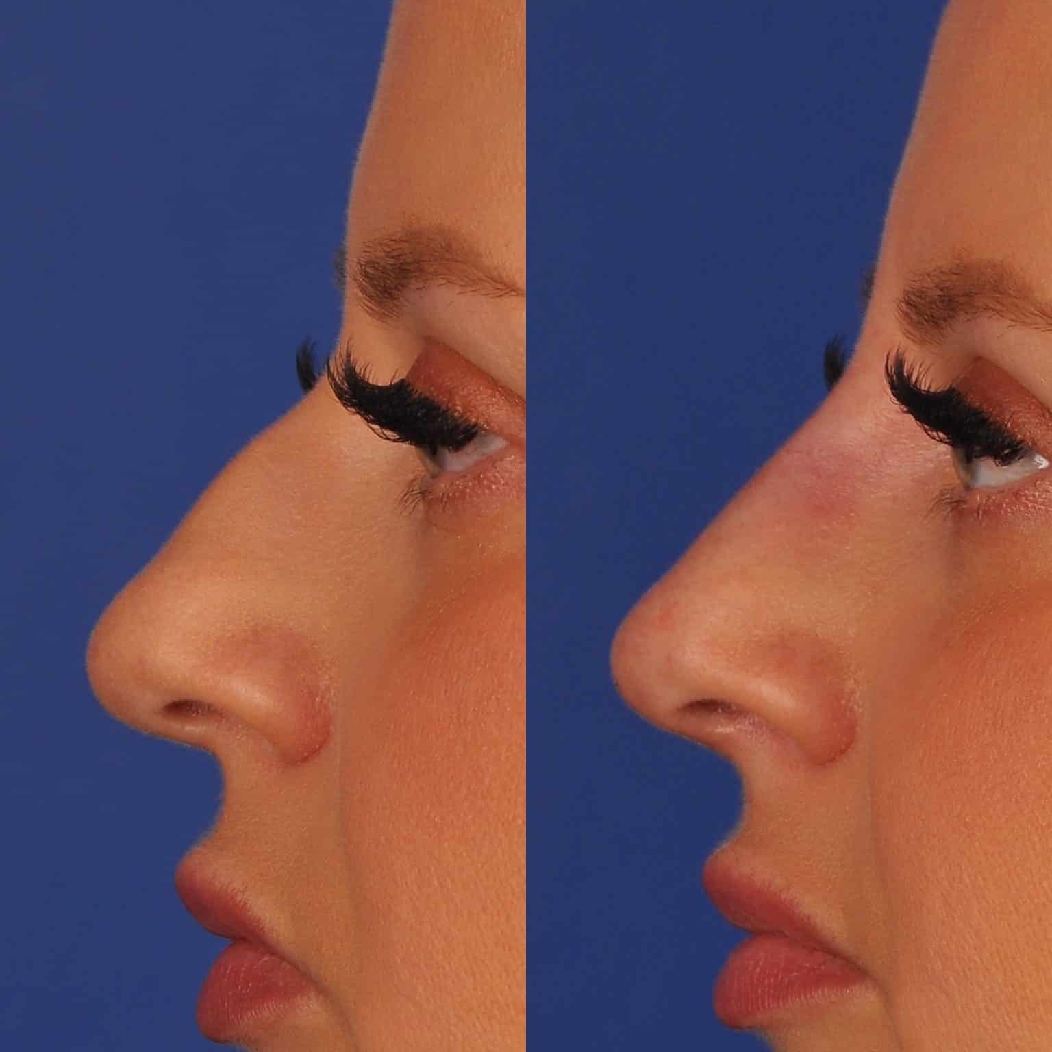 Before and After Image: Liquid Rhinoplasty - left-side