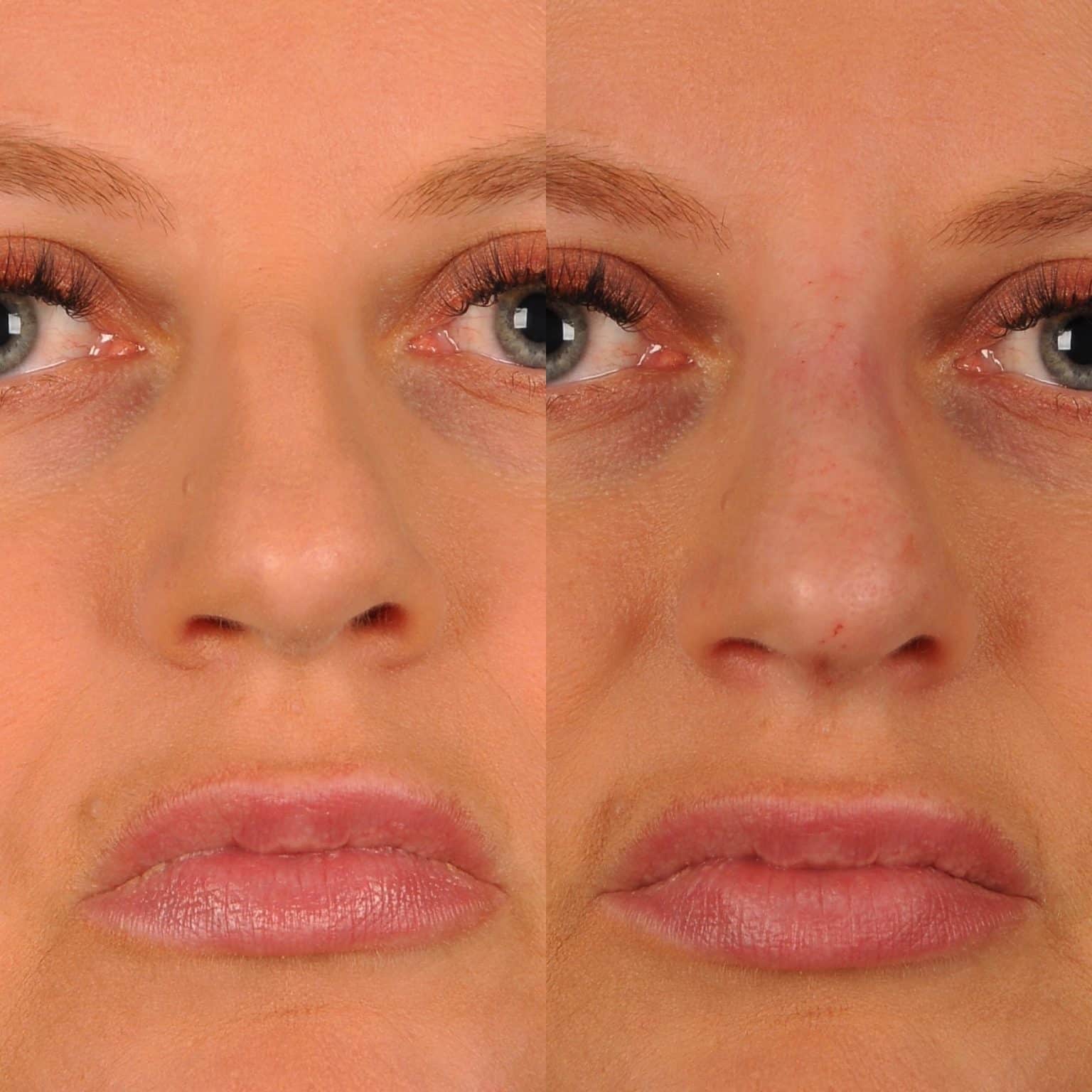 Before and After Image: Liquid Rhinoplasty - front