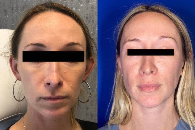 Before and After Image: PRP Tear Trough Filler - front