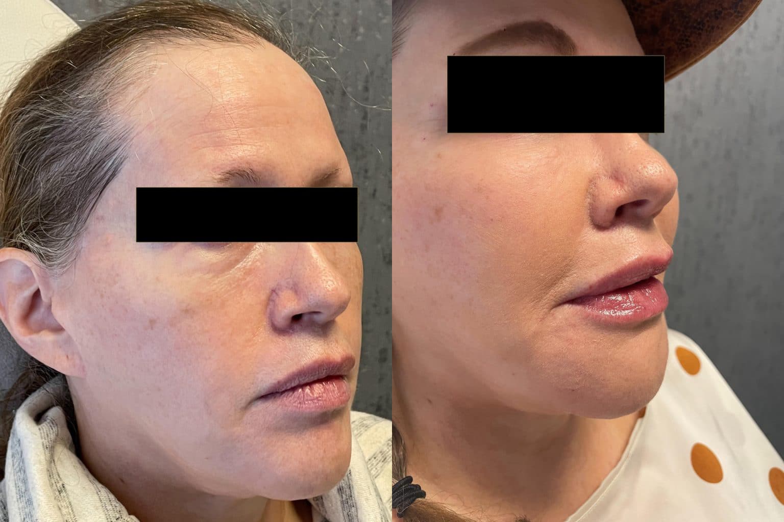 Before and After Image: PRP Tear Trough Filler - right-front-oblique