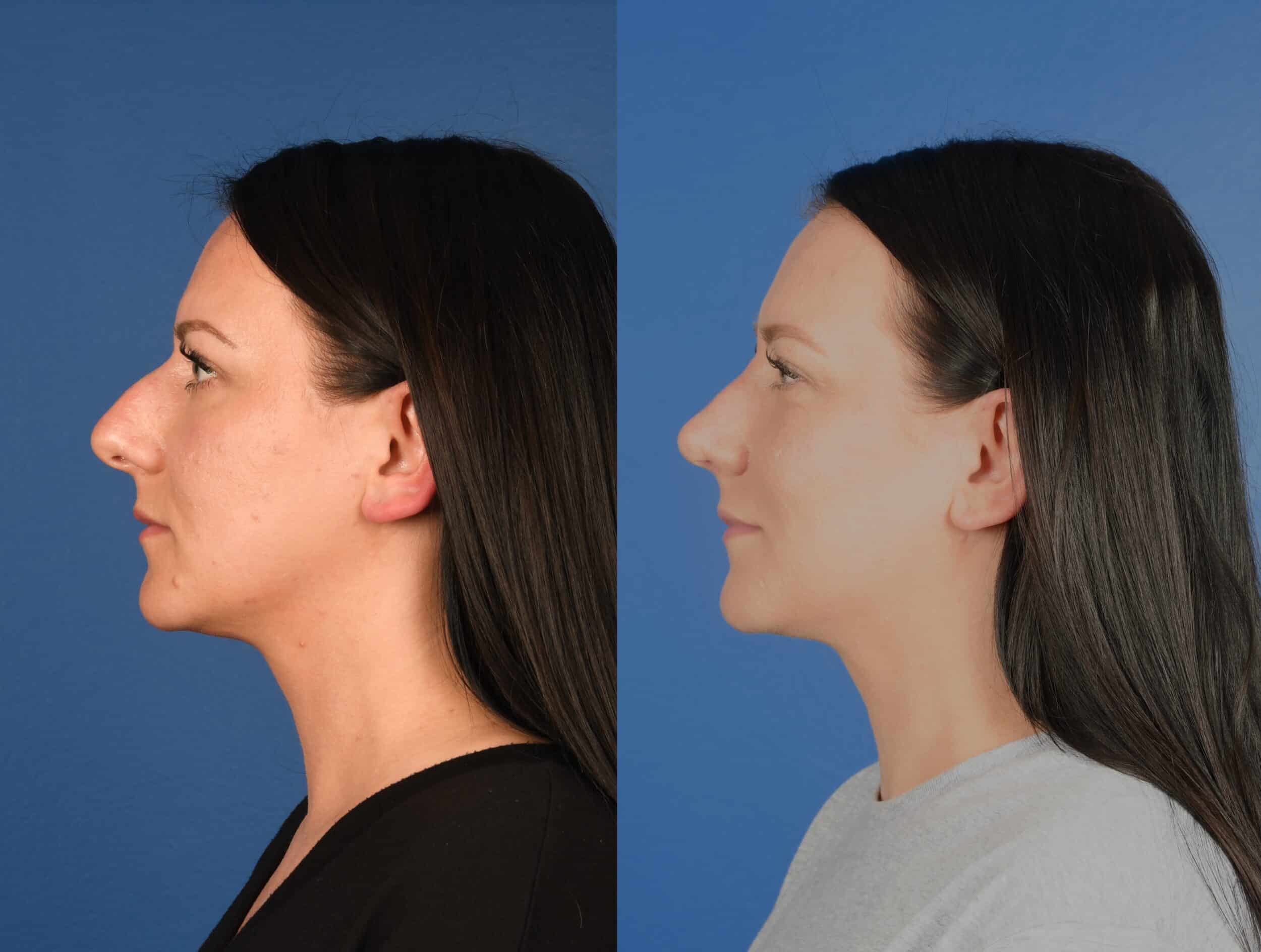 Before and After Image: Primary Rhinoplasty - left-side