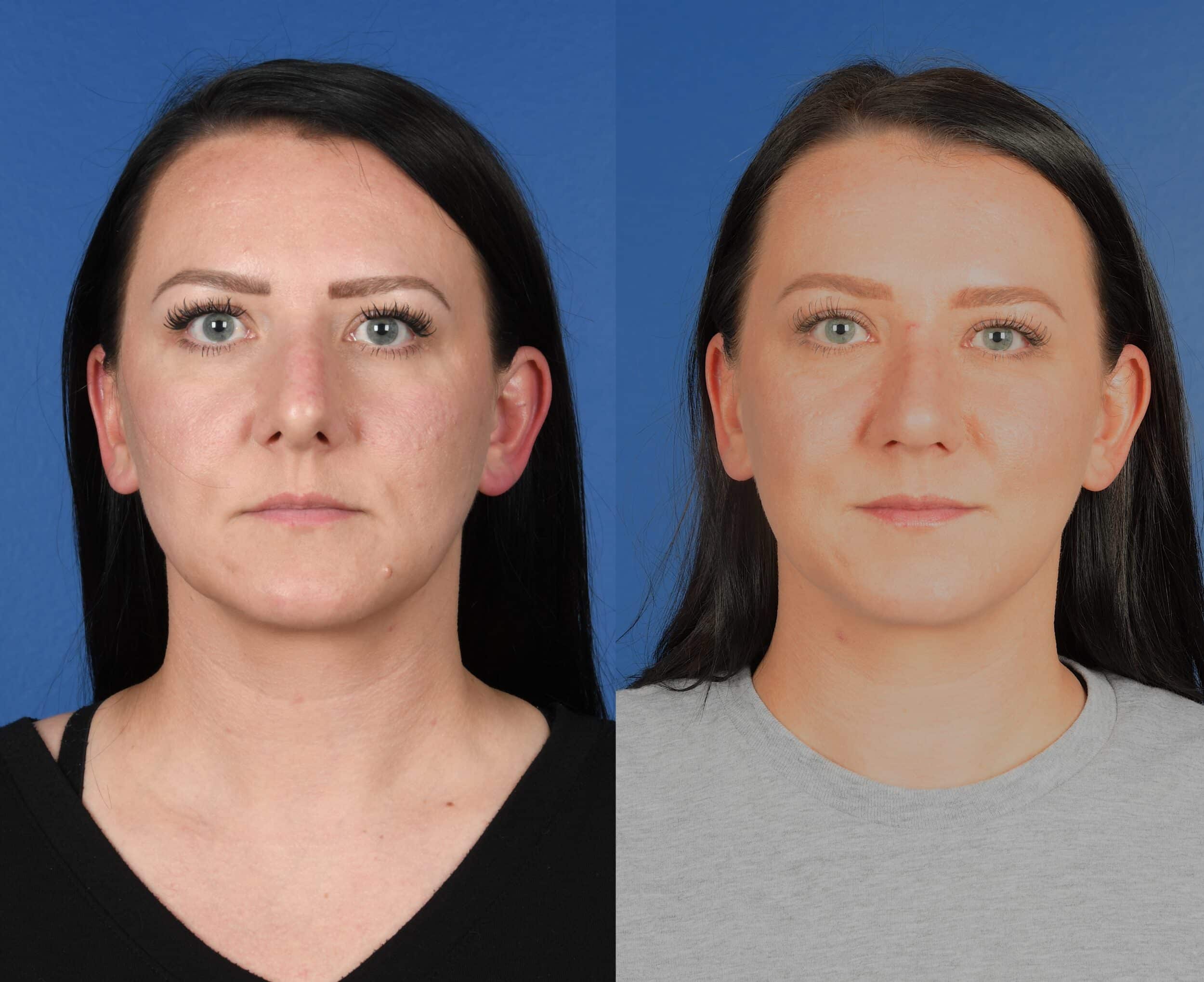 Before and After Image: Primary Rhinoplasty - front