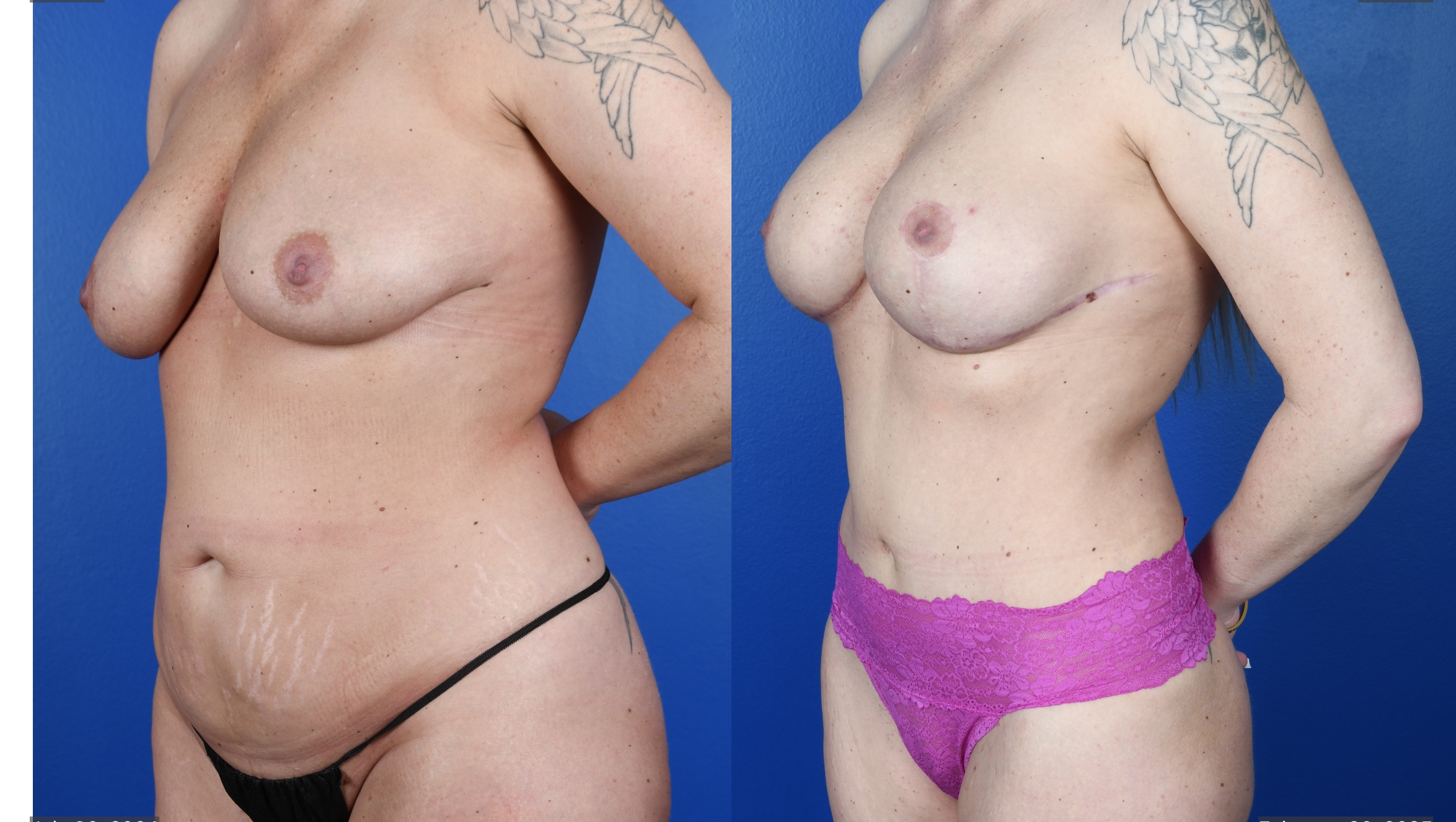 Before and After Image: Abdominoplasty- Standard, Liposuction 360, Breast Augmentation – Silicone, Mastopexy - left-front-oblique