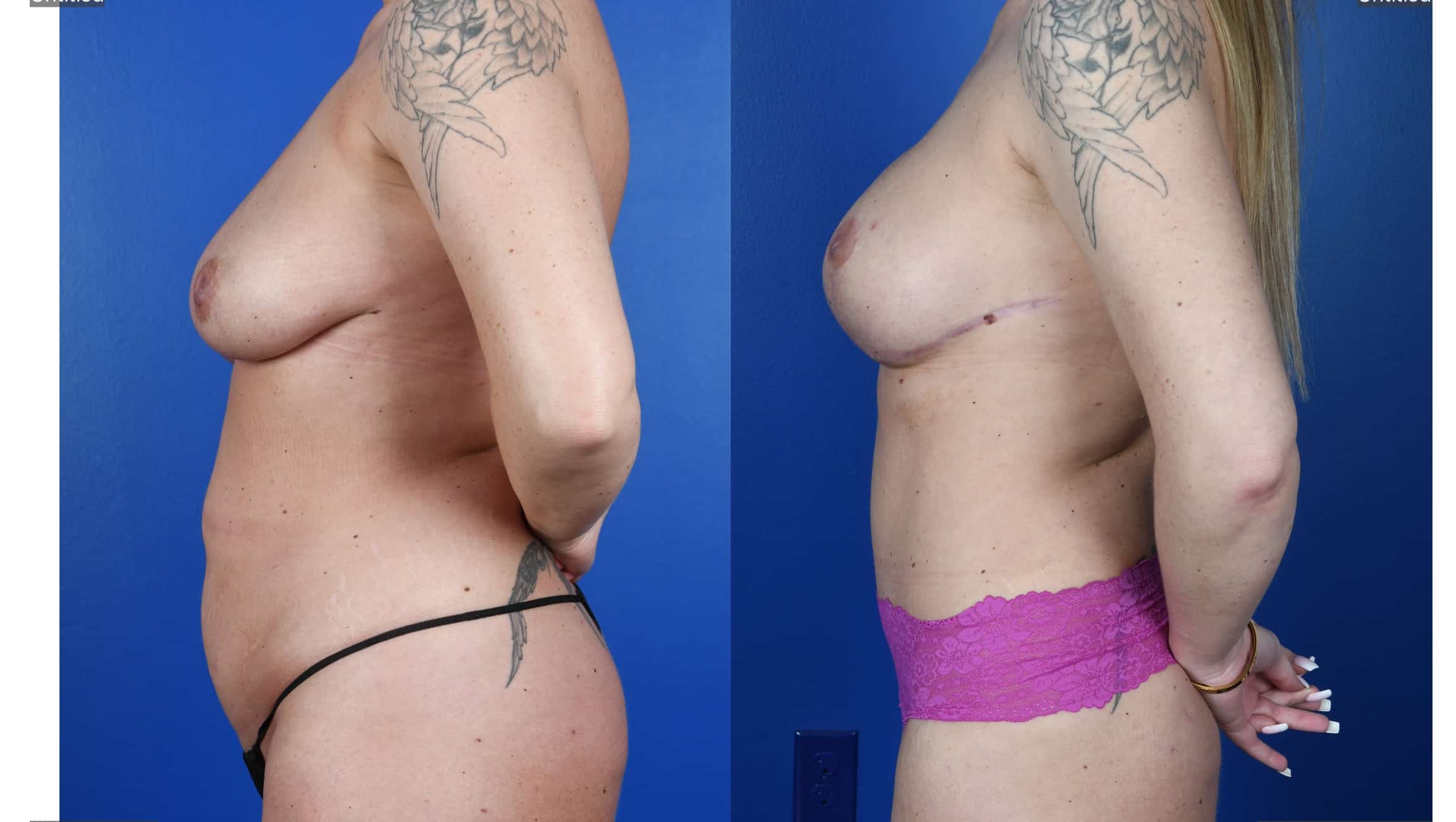 Before and After Image: Abdominoplasty- Standard, Liposuction 360, Breast Augmentation – Silicone, Mastopexy - left-side