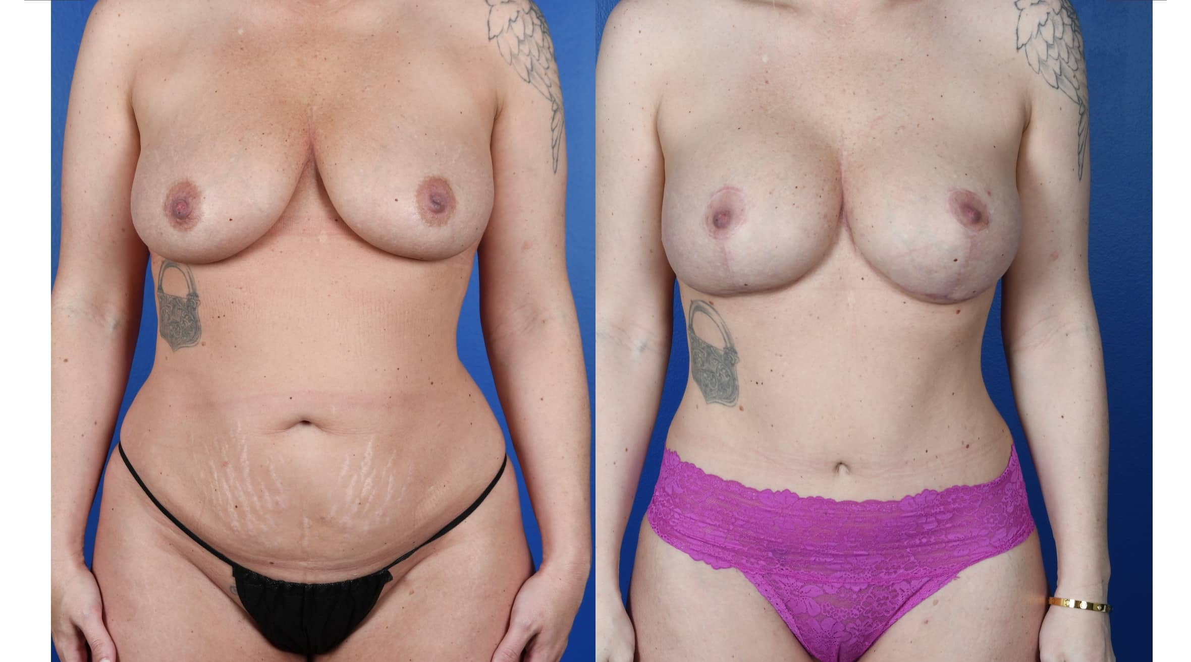 Before and After Image: Abdominoplasty- Standard, Liposuction 360, Breast Augmentation – Silicone, Mastopexy - front