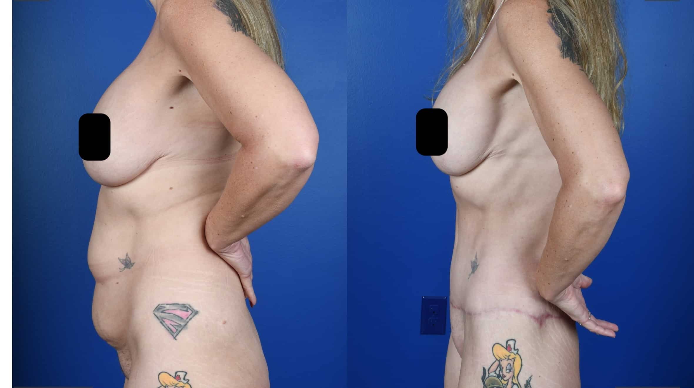 Before and After Image: Extended Abdominoplasty - left-side