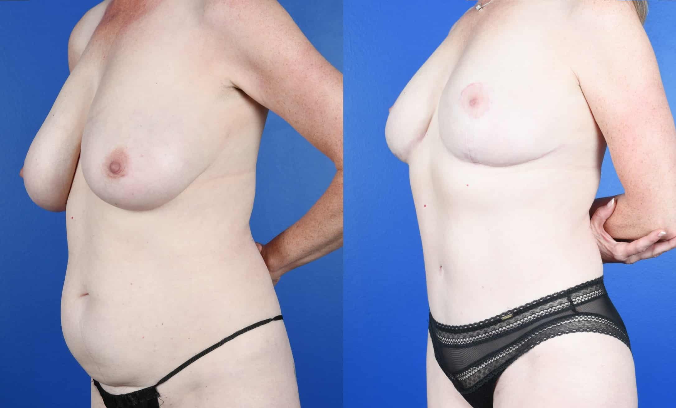 Before and After Image: Bilateral Breast Reduction, Abdominoplasty, 360 Liposuction - left-front-oblique