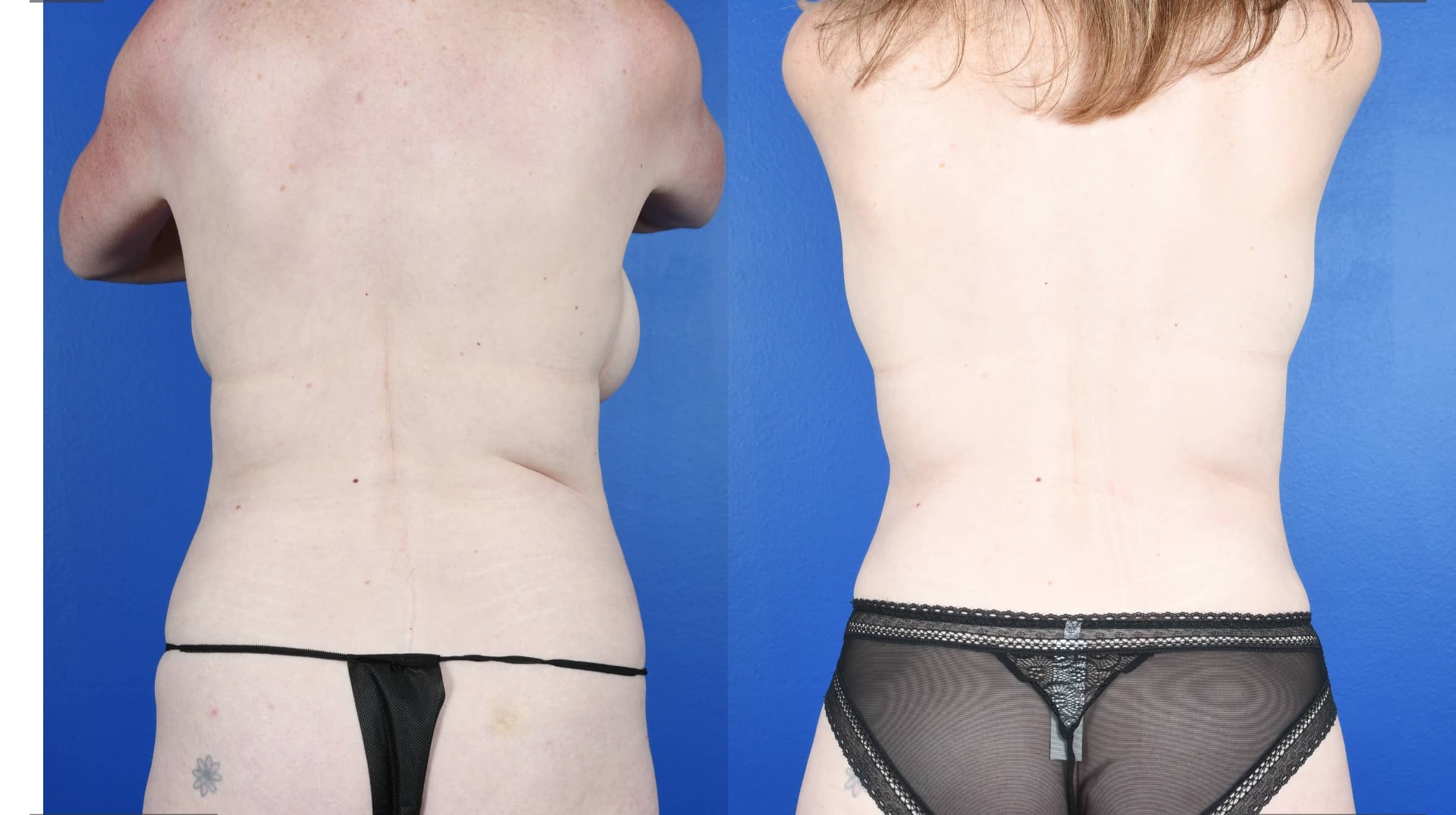 Before and After Image: Bilateral Breast Reduction, Abdominoplasty, 360 Liposuction - back