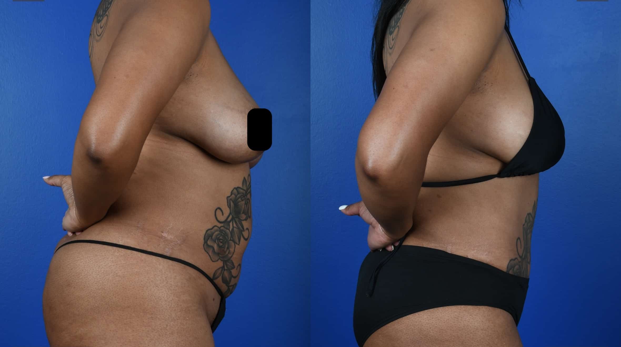 Before and After Image: Abdominoplasty, 360 VASER Liposuction - right-side