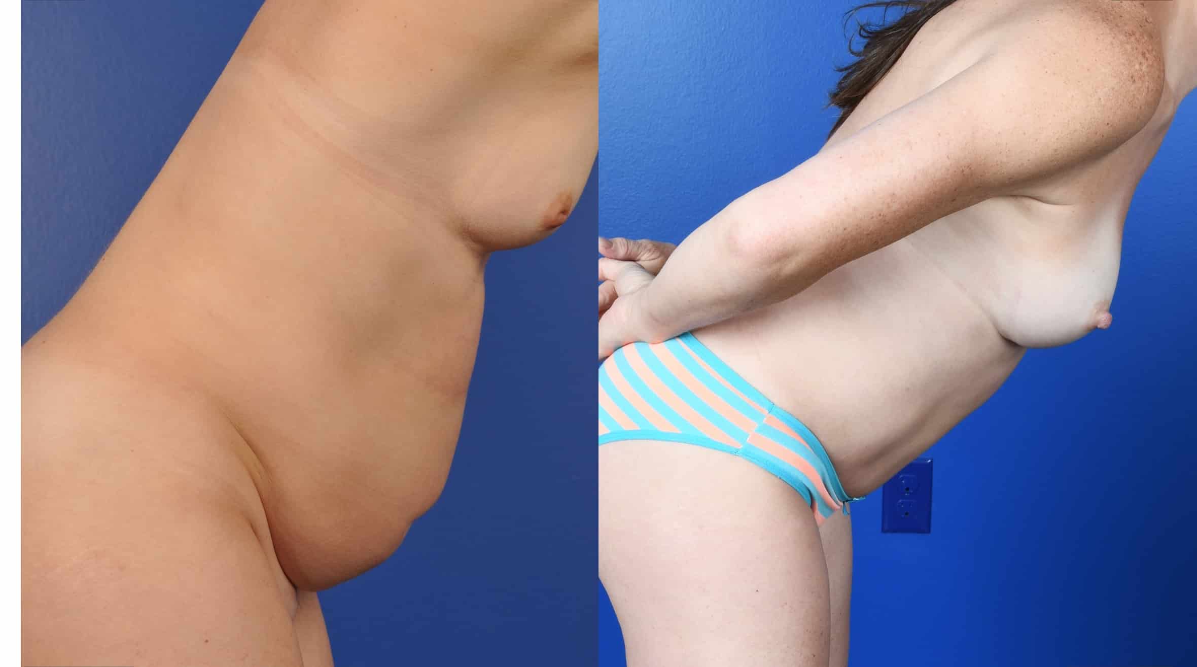 Before and After Image: Abdominoplasty, 360 Liposuction, Axillary Liposuction, Breast Augmentation – Silicone, Inverted Nipple Repair - other